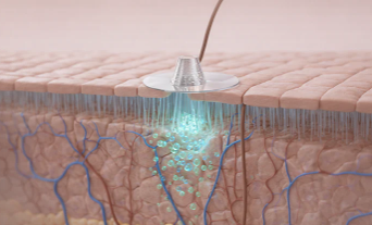Werking van de microneedle oogpatches